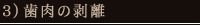 3）歯肉の剥離